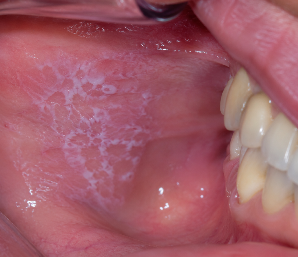 Liquen plano oral: causas, síntomas y tratamiento de las manchas blancas en la boca